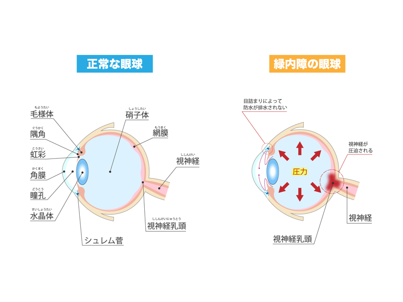 緑内障 | お茶の水頭痛めまいクリニック